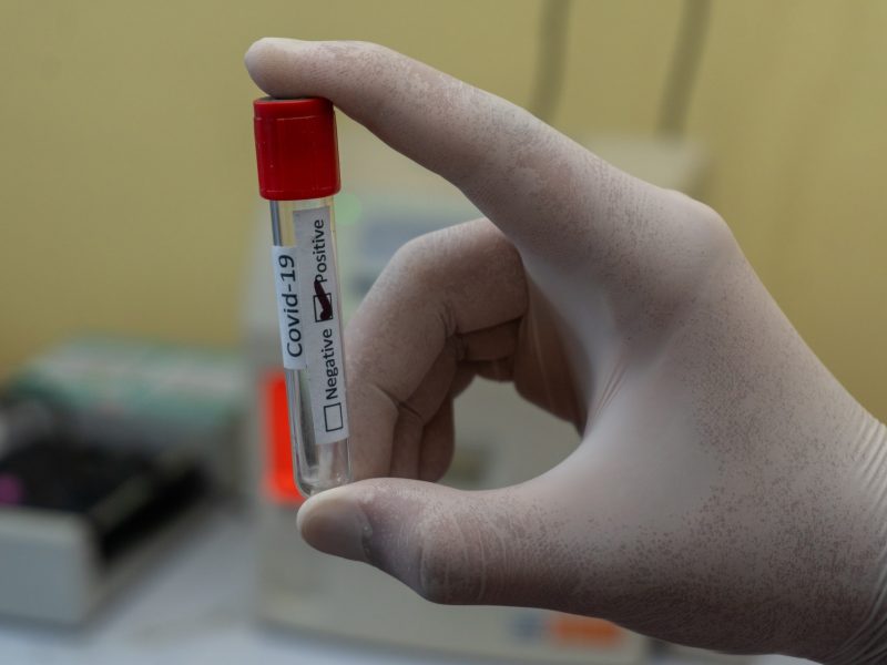 Vědci zkoumají souvislost koronavirových variant a neléčeného HIV