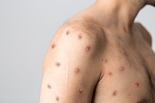 Meziročně přibylo případů desítky infekcí, vrátily se spalničky nebo mpox