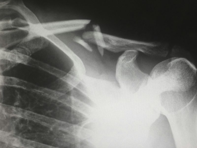 Tisíce pacientů přišly k praktikům zjistit, zda jim řídnou kosti – Zlomeniny kvůli osteoporóze vážně ohrožují život